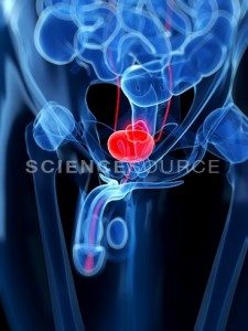 prostate cancer