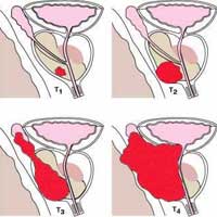 prostate cancer