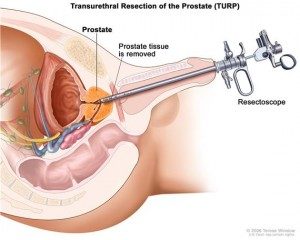 prostate