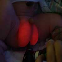 Hydrocele