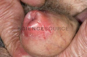 phimosis